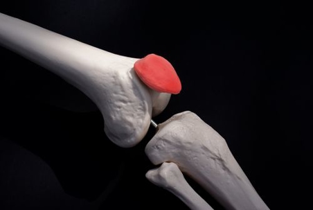 digital illustration of torn meniscus